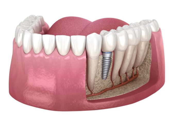 Are Denture Implants good for you to care?