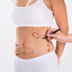 Post Pregnancy Liposuction Options in Dubai