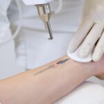 Laser tattoo Removal