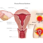 Understanding the Ovarian Remnant Syndrome