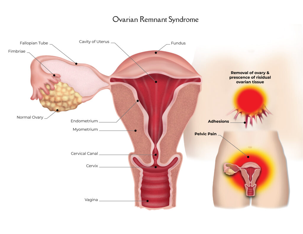 Understanding the Ovarian Remnant Syndrome