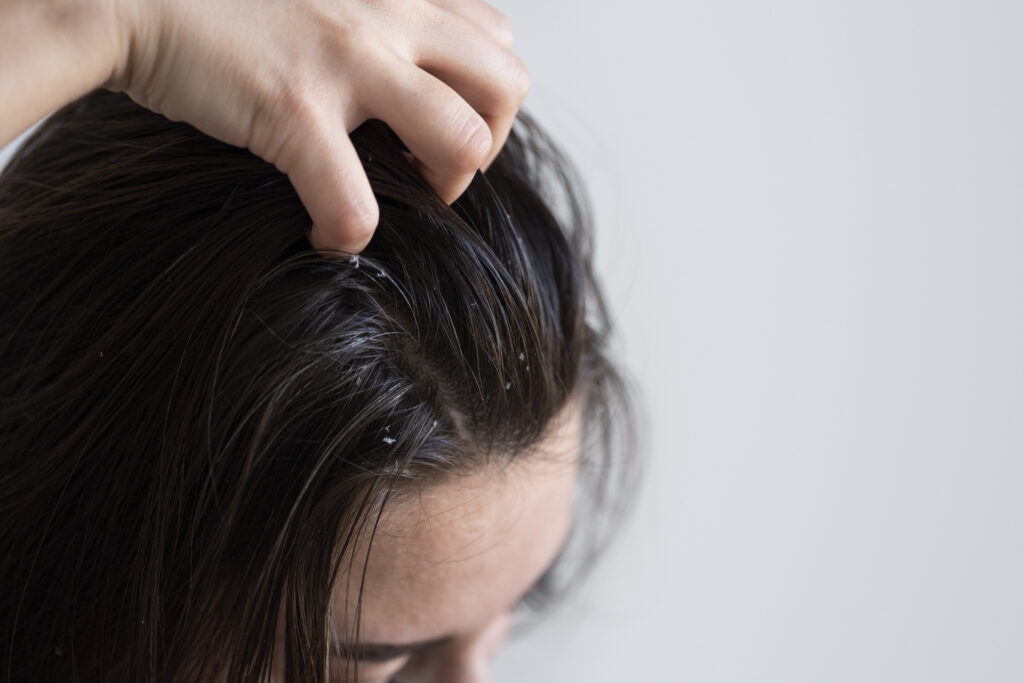 a woman having hair fall issue