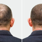 Understand Hair Transplant Process in Riyadh: A Patient’s Perspective