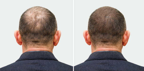 Understand Hair Transplant Process in Riyadh: A Patient’s Perspective