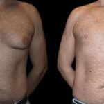 before and after male breast reduction results