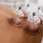 hijama