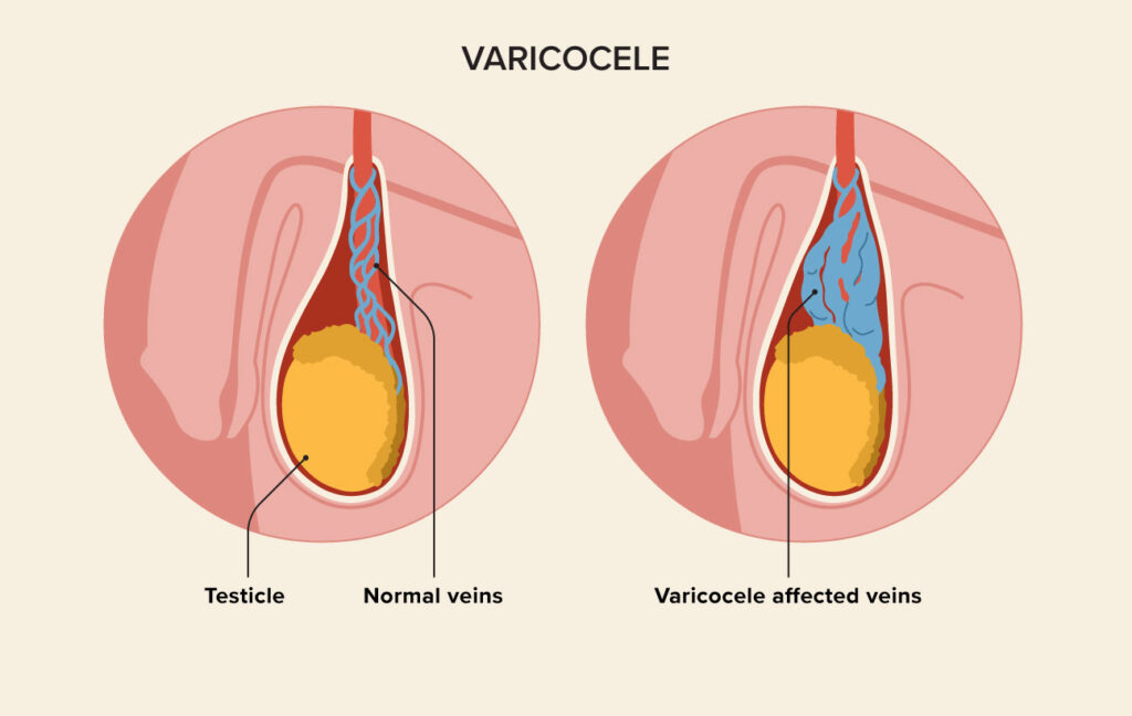 varicocele treatment