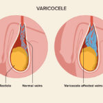 varicocele treatment