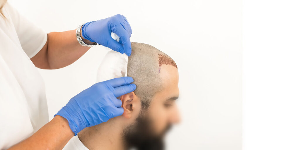 تكلفة زراعة الشعر