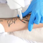 LASER-TATTOO-REMOVAL