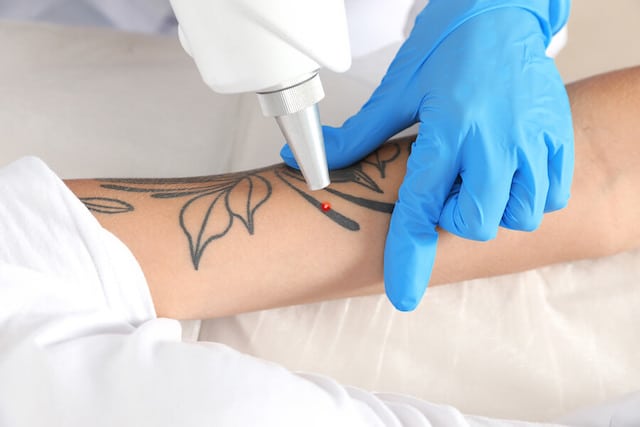 LASER-TATTOO-REMOVAL