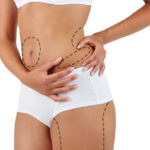 Liposuction in Islamabad