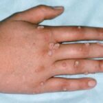 wart removal hand in Islamabad